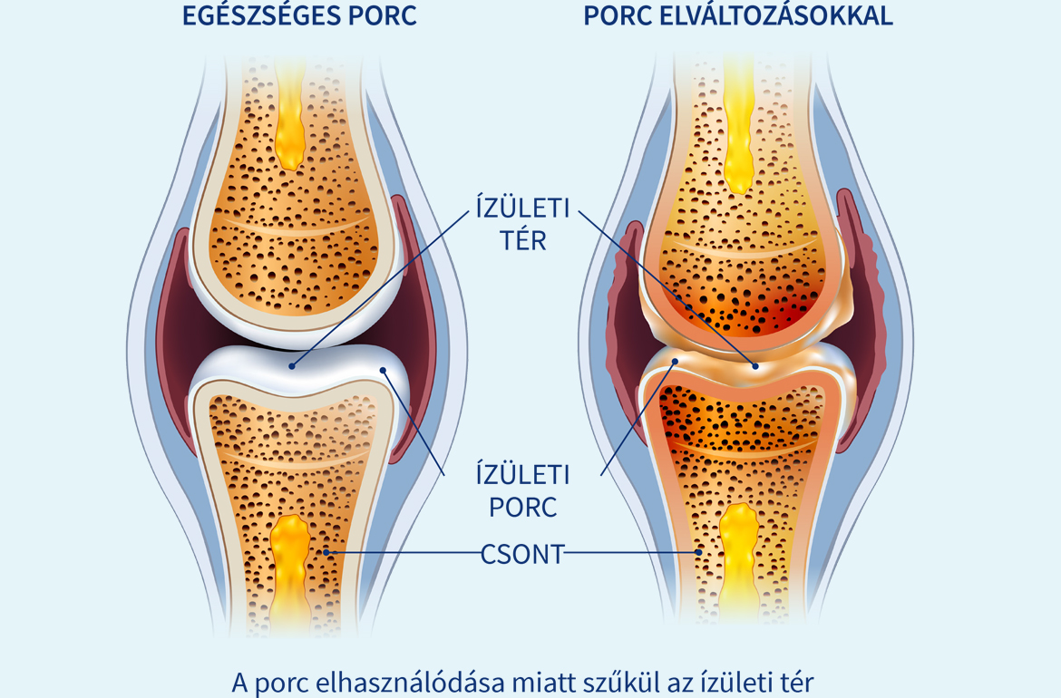 Porc - ízületeink lengéscsillapítója